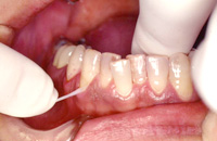 歯科衛生士によるPMTC（プロフェッショナル・メカニカル・トゥース・クリーニング）1