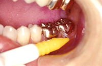 歯科衛生士によるPMTC（プロフェッショナル・メカニカル・トゥース・クリーニング）2