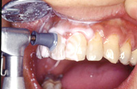 歯科衛生士によるPMTC（プロフェッショナル・メカニカル・トゥース・クリーニング）4